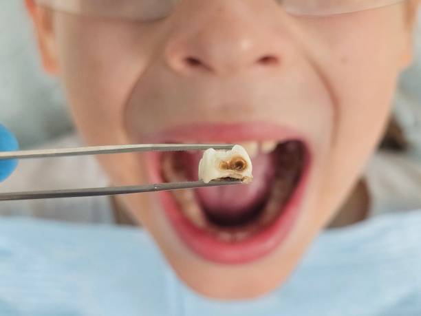 Best Emergency Wisdom Teeth Removal in Kuna, ID